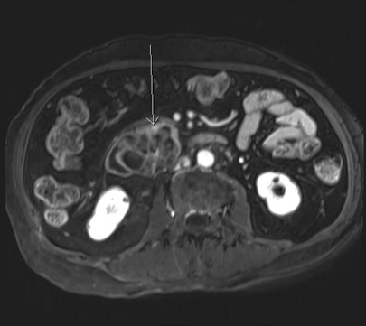 胰臟頭部胰管內乳頭狀黏液性腫瘤